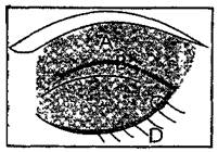 Рис. 27. Узкие веки